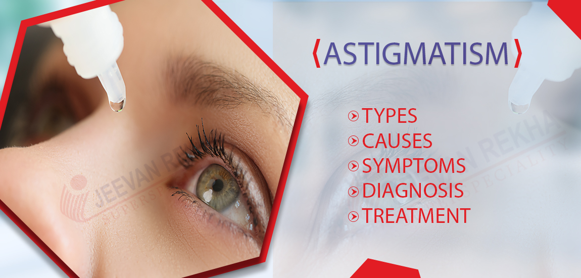 Astigmatism: Types, Causes, Symptoms, Diagnosis, and Treatment