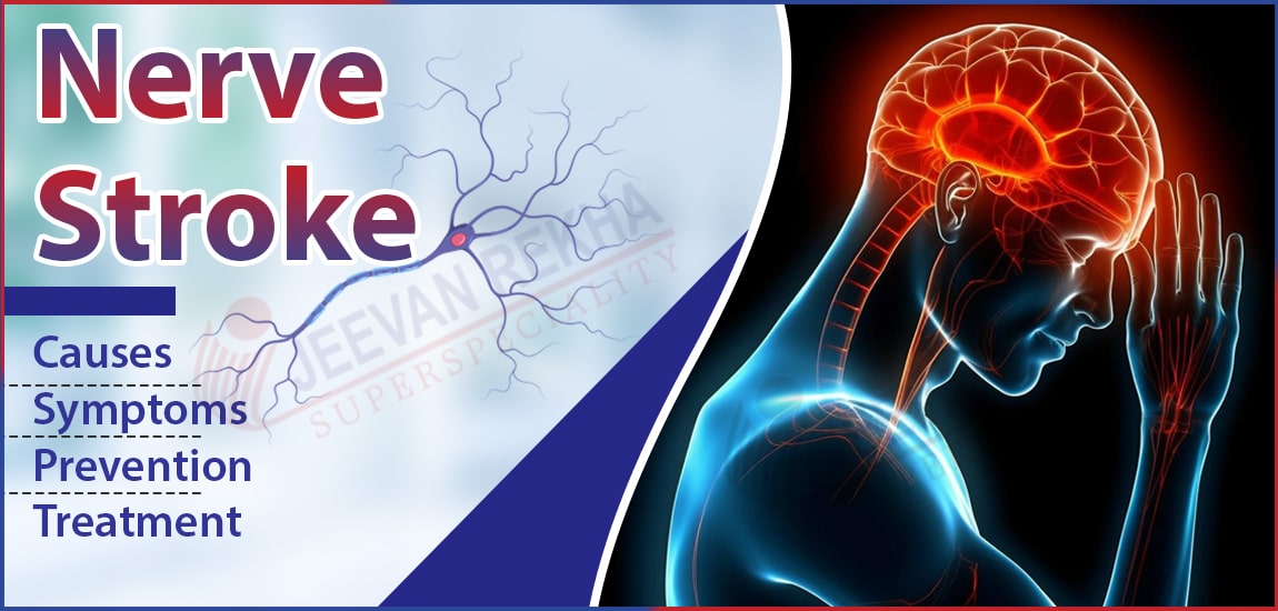 Nerve Stroke: What It Is, Causes, Symptoms & Prevention and Treatment