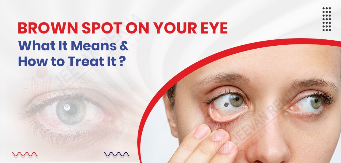 Brown Spot on Your Eye: What It Means and How to Treat It
