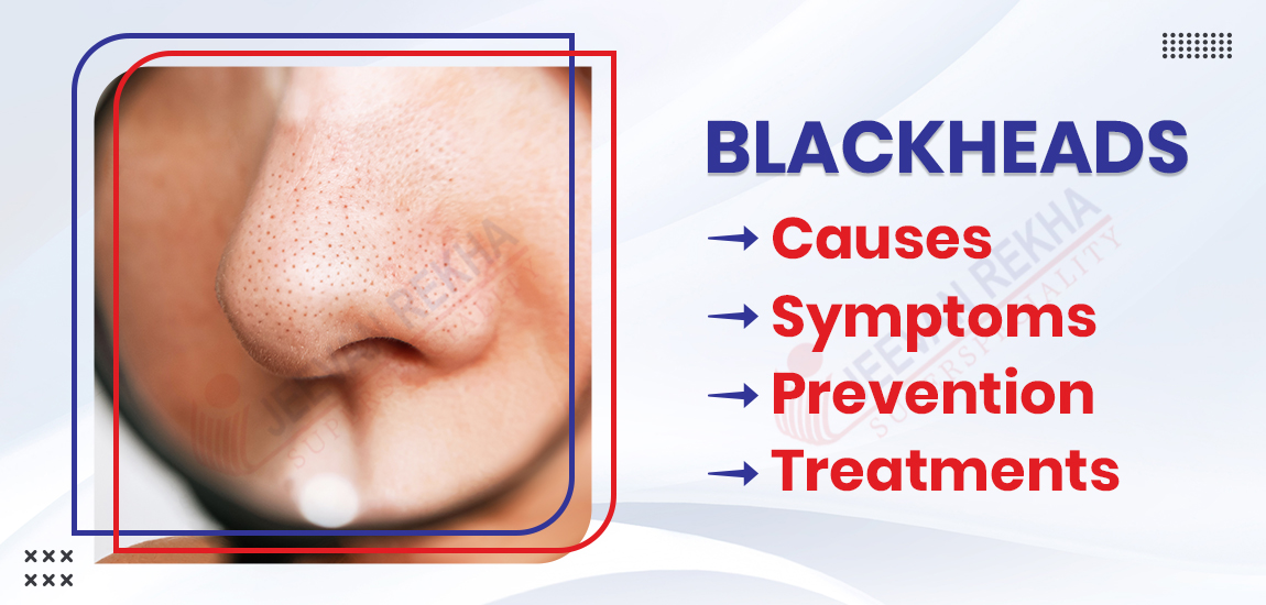 Blackheads: Causes, Symptoms, Prevention, and Treatments