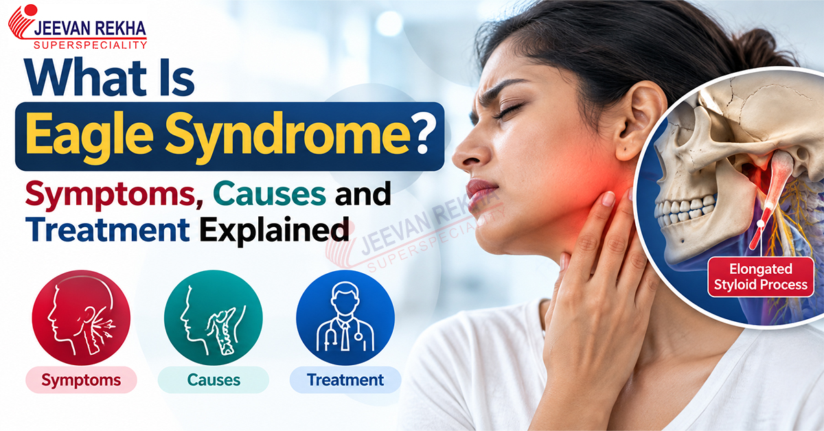 What Is Eagle Syndrome? Symptoms, Causes and Treatment Explained