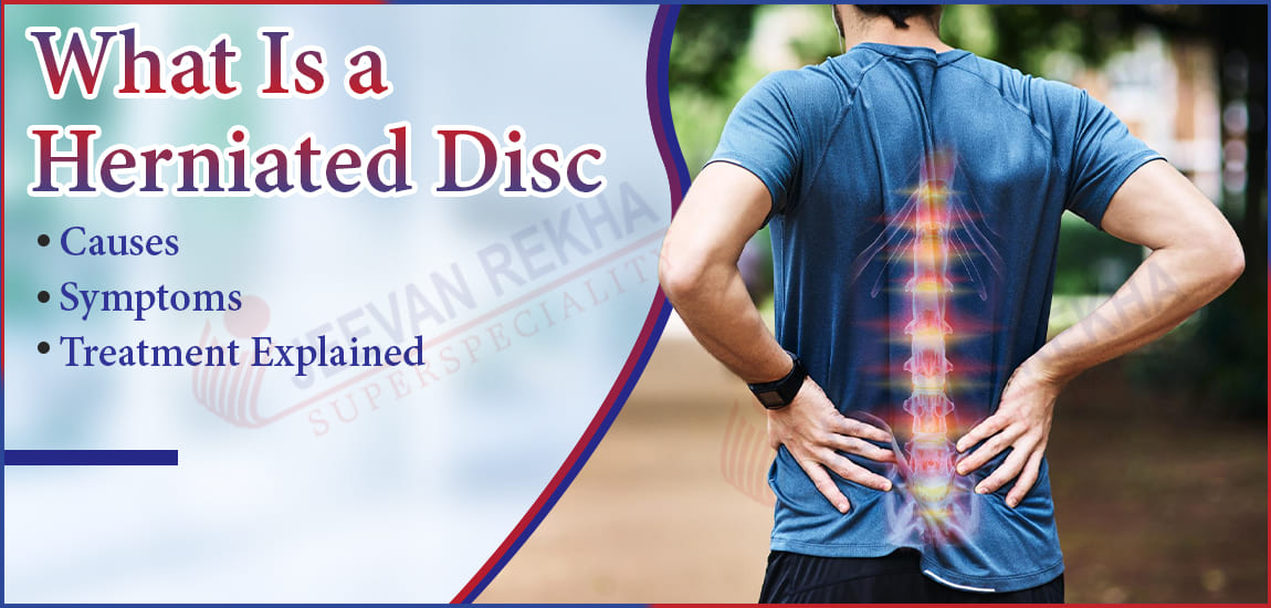 What Is a Herniated Disc? Causes, Symptoms & Treatment Explained