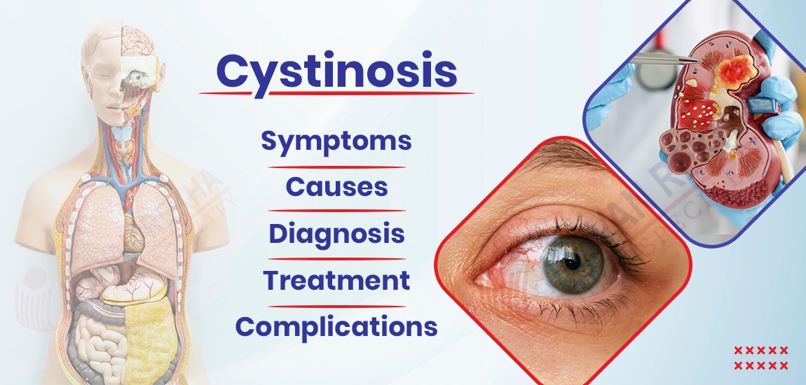 Cystinosis: Symptoms, Causes, Diagnosis, Treatment and Complications