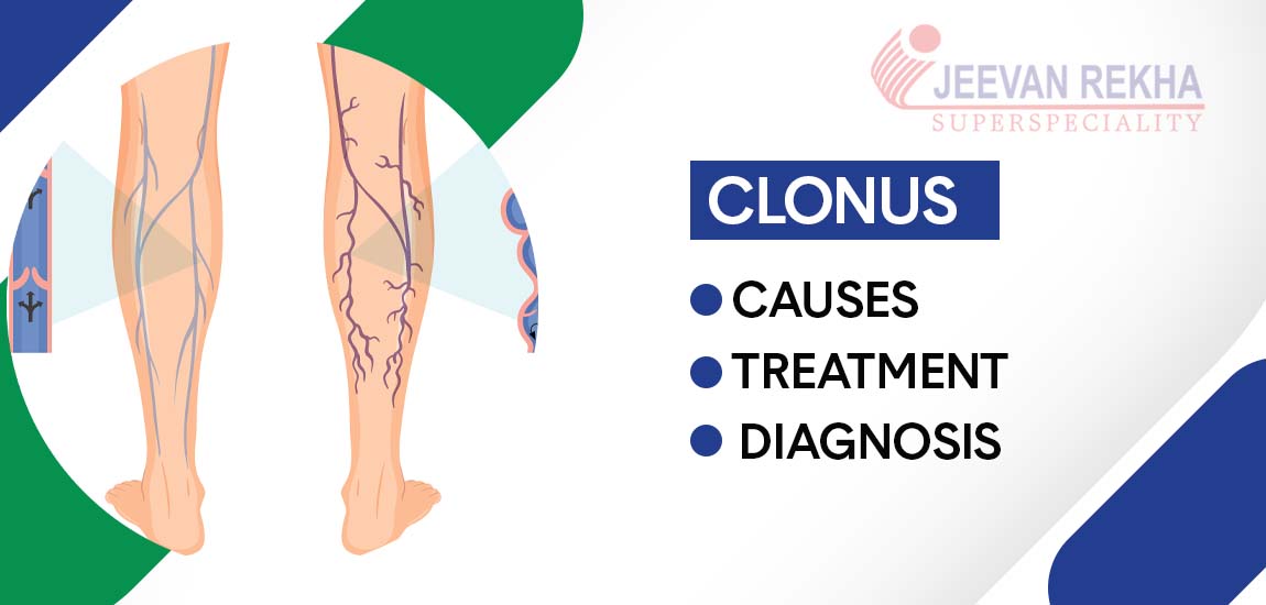 Clonus: Causes, Diagnosis, and Treatment