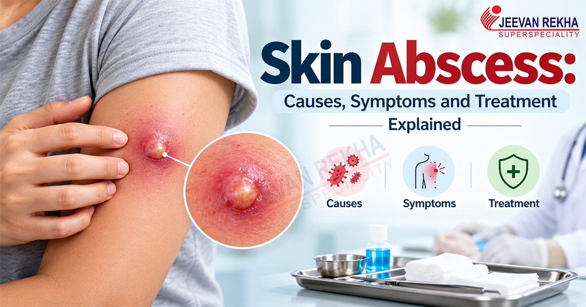 Skin Abscess: Causes, Symptoms and Treatment Explained