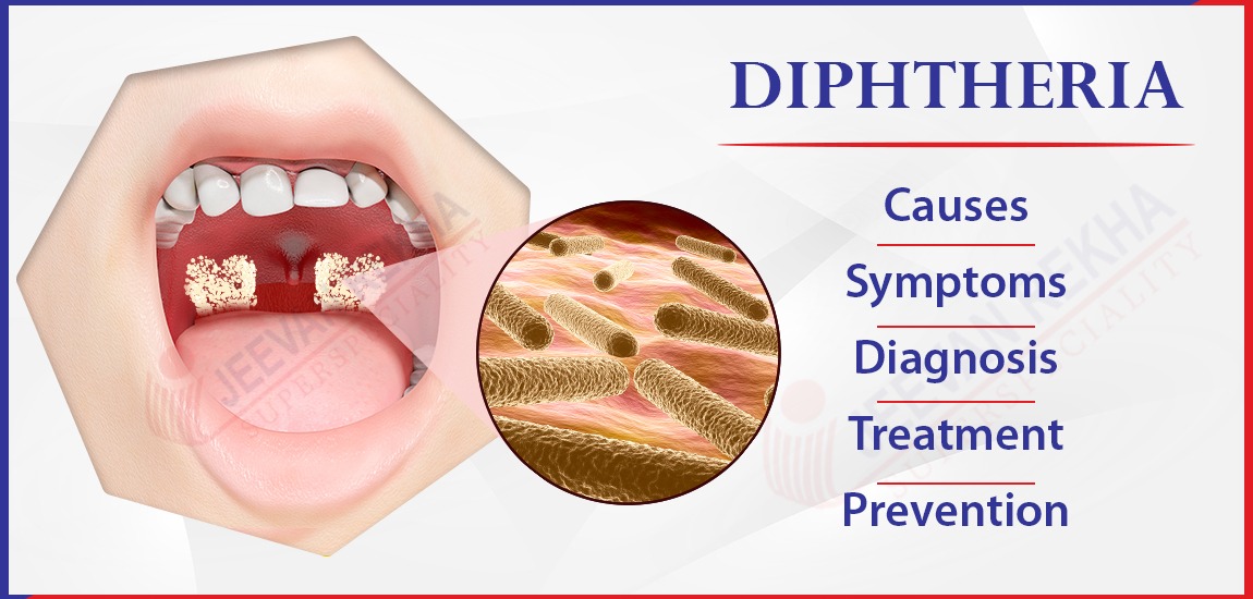 Diphtheria: Causes, Symptoms, Diagnosis, Treatment & Prevention