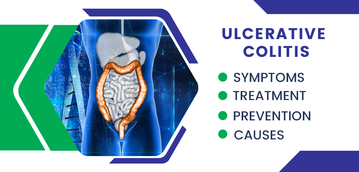 Ulcerative Colitis: Symptoms, Causes, Treatment, and Prevention